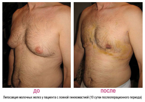 Фото до и после увеличения груди — пластическая хирургия